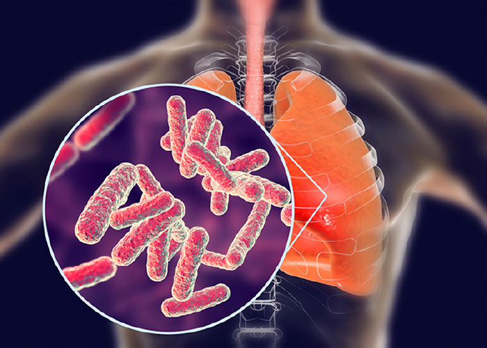 TUBERCULOSIS EXTRAPULMONAR